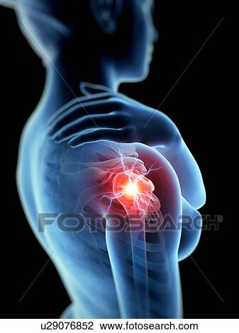 Human shoulder joint pain, illustration View Large Illustration Drawing - Human shoulder joint pain, illustration. Fotosearch