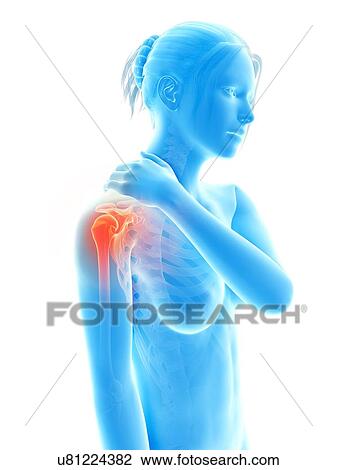 Drawing - Human shoulder pain, illustration. Fotosearch