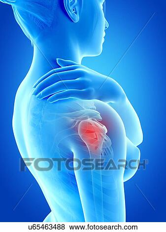 Stock Illustration - Human shoulder pain, illustration. Fotosearch