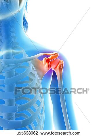 Drawing - Inflamed human shoulder, illustration. Fotosearch