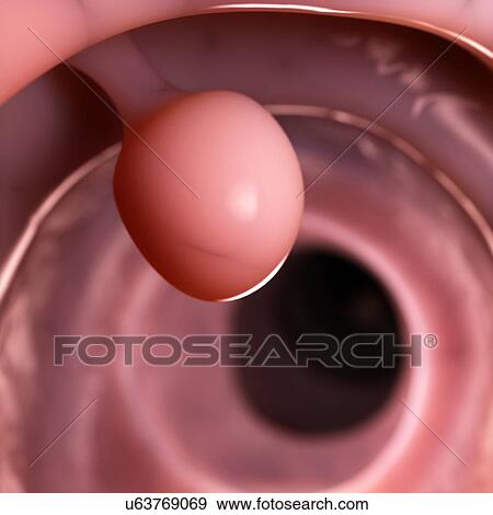 Polyp in the human colon, illustration View Large Illustration Stock Illustration - Polyp in the human colon, illustration. Fotosearch
