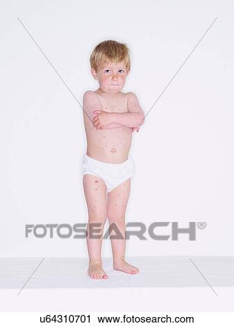 Portrait of toddler boy with chickenpox View Large Photo Image Stock Image - Portrait of toddler boy with chickenpox. Fotosearch