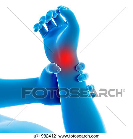 Drawing - "Human wrist pain, illustration". Fotosearch