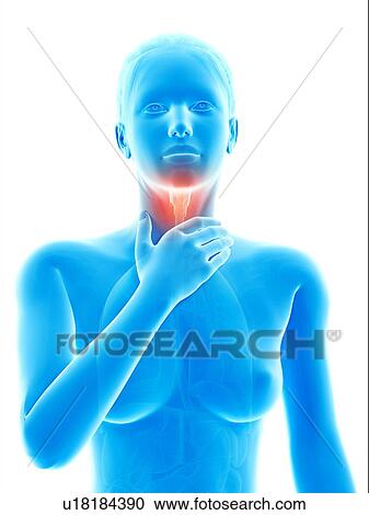 Clipart - "Inflammation of the larynx, illustration". Fotosearch