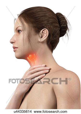 Stock Illustration - "Inflammation of the larynx, illustration". Fotosearch