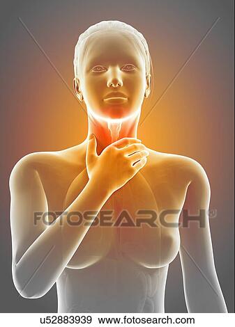 Stock Illustration - "Inflammation of the larynx, illustration". Fotosearch