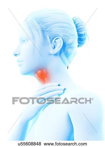 Stock Illustration - "Inflammation of the larynx, illustration". Fotosearch