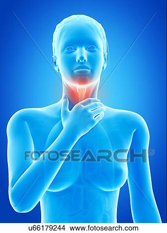 "Inflammation of the larynx, illustration" View Large Illustration Stock Illustration - "Inflammation of the larynx, illustration". Fotosearch