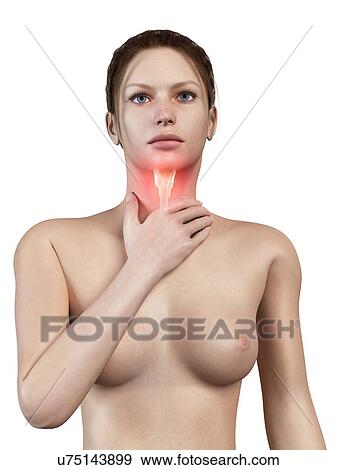 Stock Illustration - "Inflammation of the larynx, illustration". Fotosearch