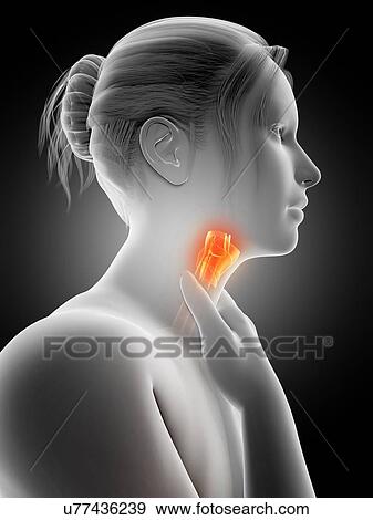 Stock Illustration - "Inflammation of the larynx, illustration". Fotosearch