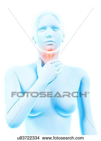 Stock Illustration - "Inflammation of the larynx, illustration". Fotosearch