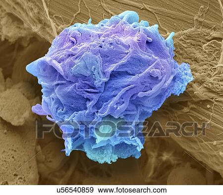 Stock Illustration - "Lymphoma cancer cell, SEM". Fotosearch