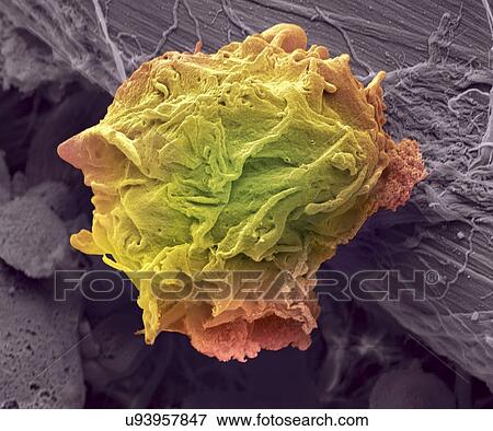 Stock Illustration - "Lymphoma cancer cell, SEM". Fotosearch