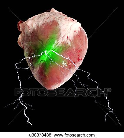 Stock Illustration - Heart attack. Fotosearch