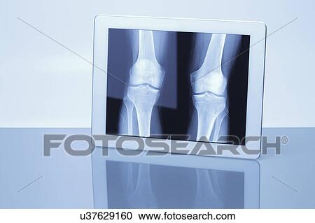 Digital tablet displaying X-ray image of knees View Large Photo Image Stock Image - Digital tablet displaying X-ray image of knees. Fotosearch
