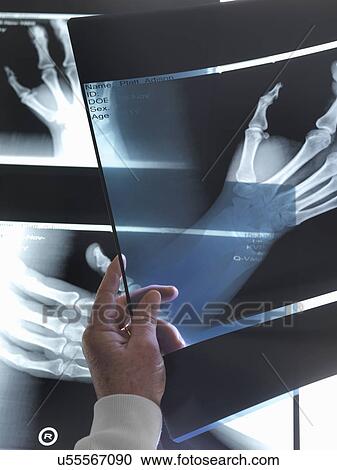 Stock Image - Doctor viewing x-rays of hand in hospital. Fotosearch