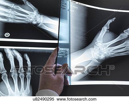 Stock Photography - Doctors hand holding up hand xray in hospital. Fotosearch