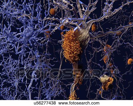 Stock Illustration - Brain nerve cells affected by alzheimers. Fotosearch