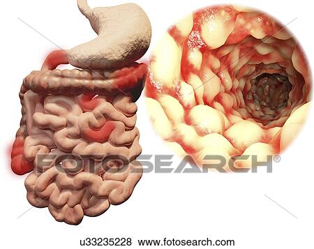 "Crohn's disease, illustration" View Large Illustration Stock Illustration - "Crohn's disease, illustration". Fotosearch