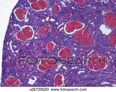 Clipart - Glomerulonephritis, light micrograph. Fotosearch