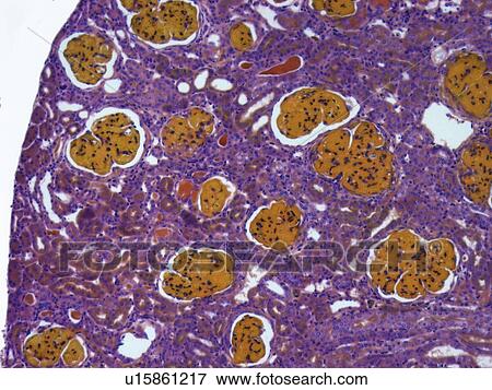 Stock Illustration - Glomerulonephritis, light micrograph. Fotosearch