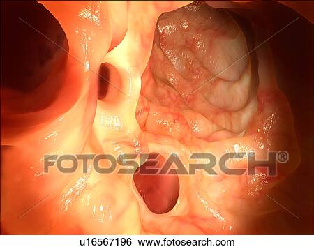 "Intestinal diverticuli, illustration" View Large Illustration Stock Illustration - "Intestinal diverticuli, illustration". Fotosearch