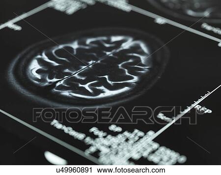 Stock Image - MRI brain scans. Fotosearch
