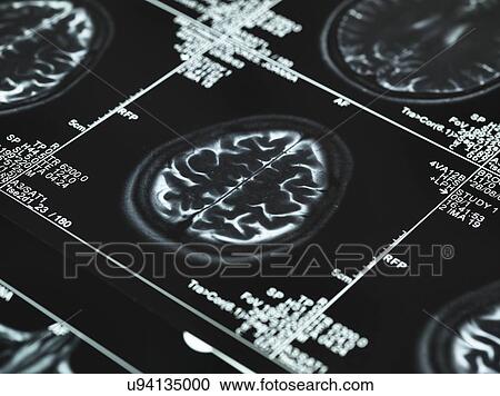 Stock Image - MRI brain scans. Fotosearch