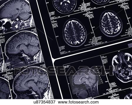 MRI brain scans View Large Photo Image Stock Photo - MRI brain scans. Fotosearch