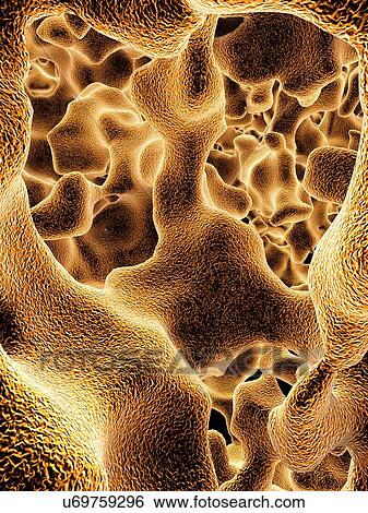 Stock Illustration - Osteoporotic bone, artwork. Fotosearch