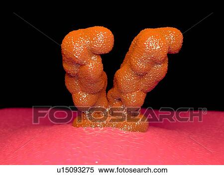 Teratoma tumor, illustration View Large Illustration Stock Illustration - Teratoma tumor, illustration. Fotosearch