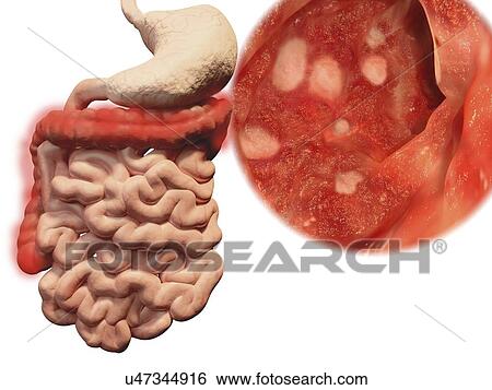 "Ulcerative colitis, illustration" View Large Illustration Stock Illustration - "Ulcerative colitis, illustration". Fotosearch