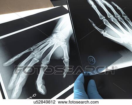 Drawing - X-rays of hands. Fotosearch