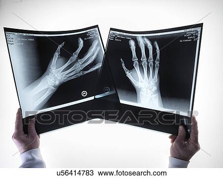 X-rays of hands View Large Illustration Drawing - X-rays of hands. Fotosearch