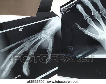 X-rays of hands View Large Illustration Drawing - X-rays of hands. Fotosearch