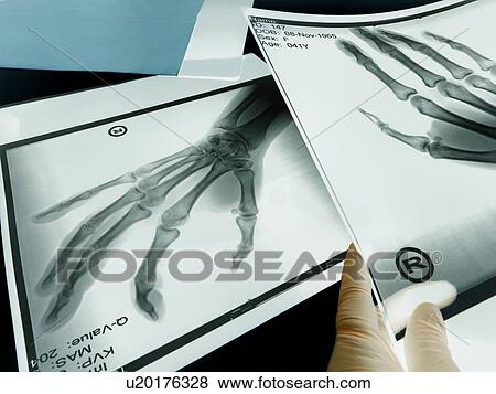 X-rays of hands View Large Illustration Stock Illustration - X-rays of hands. Fotosearch