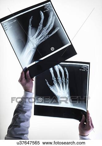 X-rays of hands View Large Illustration Stock Illustration - X-rays of hands. Fotosearch