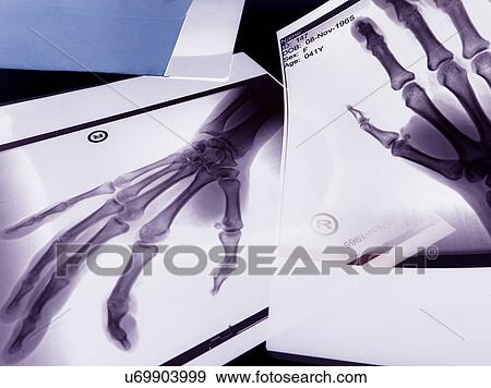 X-rays of hands View Large Illustration Stock Illustration - X-rays of hands. Fotosearch