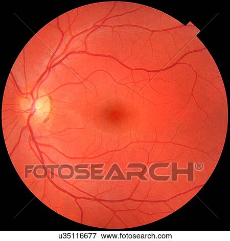 Fundus photograph of a normal left eye. Macula in center and optic disk where blood vessels converge with pigmentation on perimeter View Large Photo Image Stock Photo - Fundus photograph of a normal left eye. Macula in center and optic disk where blood vessels converge with pigmentation on perimeter. Fotosearch