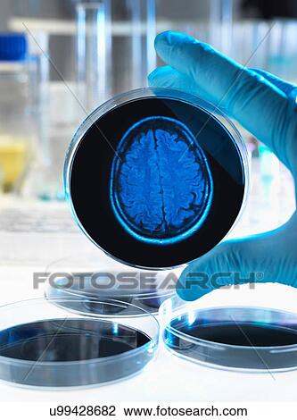 Stock Image - "Scientist holding a petri dish with a brain scan illustrating research into dementia, alzheimers and other brain disorders. ". Fotosearch