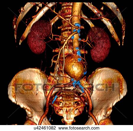 Stock Image - Three-dimensional abdominal angiographic CT scan showing a large abdominal aortic aneurysm (AAA). Also calcifications (colored blue) along the aorta and its branches which indicate atherosclerosis. Fotosearch