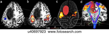 Stock Image - Brain tumor case. Anatomical T1 image, motor functional activation sites, segmented tumor in red and tumor fiber tracts around the tumor. Fotosearch