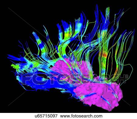 Stock Photo - Connections between putamen and frontal lobe in a Parkinson's patient brain. Fotosearch
