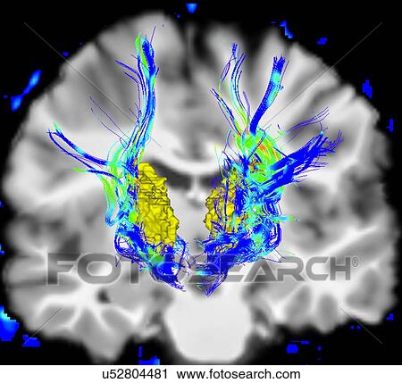 Coronal view of a human brain in Parkinson's disease. Yellow surface is the thalamus and blue/green areas highlight fibers of the motor system View Large Photo Image Stock Image - Coronal view of a human brain in Parkinson's disease. Yellow surface is the thalamus and blue/green areas highlight fibers of the motor system. Fotosearch