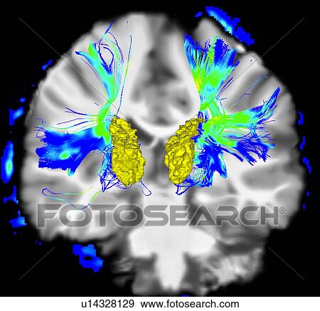 Stock Photo - Coronal view of a human brain in Parkinson's disease. Yellow surface is the caudate and blue/green areas highlight fibers of the motor system. Fotosearch