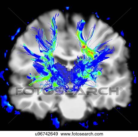 Stock Photo - Coronal view of a human brain in Parkinson's disease. Blue/green areas highlight fibers of the motor system. Fotosearch