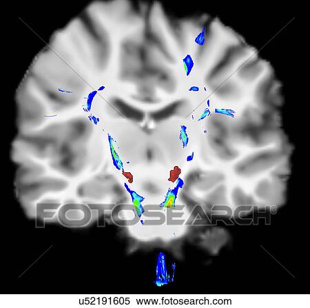 Stock Photography - Coronal view of a human brain in Parkinson's disease. Blue/green areas highlight fibers of the motor system and the red area is the substancia nigra. Fotosearch