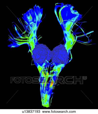 Stock Image - Cortical spinal tract, major bundle in the motor system, and thalamus in blue surface, in a Parkinson's brain. Fotosearch