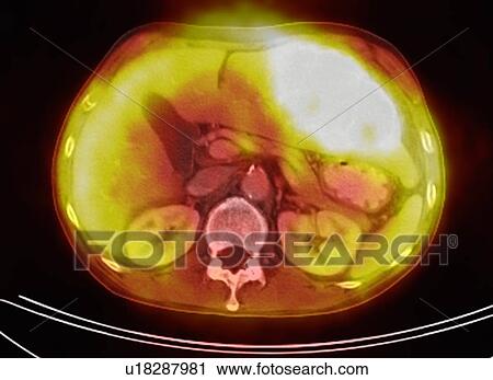 Image from a co-registered PET-CT study from dual modality scanner. Patient with multiple metastatic lesions in liver & lung. PET data superimposed over CT scan axial slice through liver metastases View Large Photo Image Stock Image - Image from a co-registered PET-CT study from dual modality scanner. Patient with multiple metastatic lesions in liver & lung. PET data superimposed over CT scan axial slice through liver metastases. Fotosearch