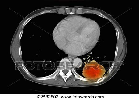 Image from a co-registered PET-CT study from dual modality scanner. Patient with multiple metastatic lesions in liver & lung. PET data superimposed over CT scan axial slice through lung metastases View Large Photo Image Stock Image - Image from a co-registered PET-CT study from dual modality scanner. Patient with multiple metastatic lesions in liver & lung. PET data superimposed over CT scan axial slice through lung metastases. Fotosearch